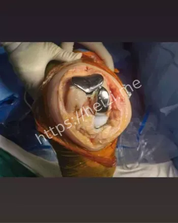 舆情夸张叙事辨析